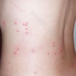 Уничтожение клопов - профессионально