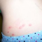 Уничтожение клопов - профессионально