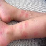 Уничтожение клопов - профессионально